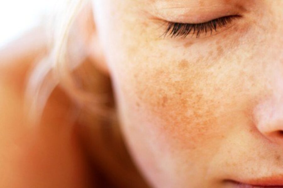 What treatments are effective for hyper-pigmentation?