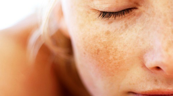 What treatments are effective for hyper-pigmentation?